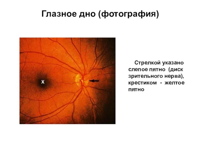 Глазное дно (фотография) Стрелкой указано слепое пятно (диск зрительного нерва), крестиком - желтое пятно