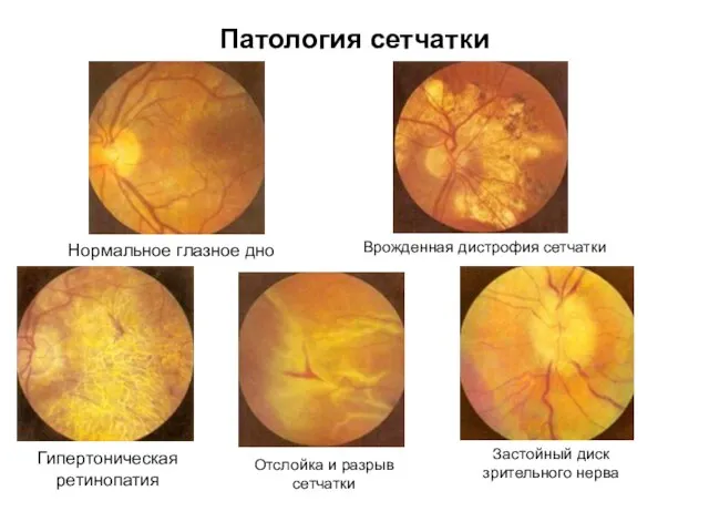 Патология сетчатки Нормальное глазное дно Гипертоническая ретинопатия Врожденная дистрофия сетчатки Отслойка