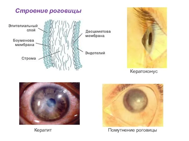 Строение роговицы Кератоконус Кератит Помутнение роговицы