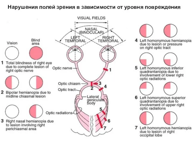 Нарушения полей зрения в зависимости от уровня повреждения