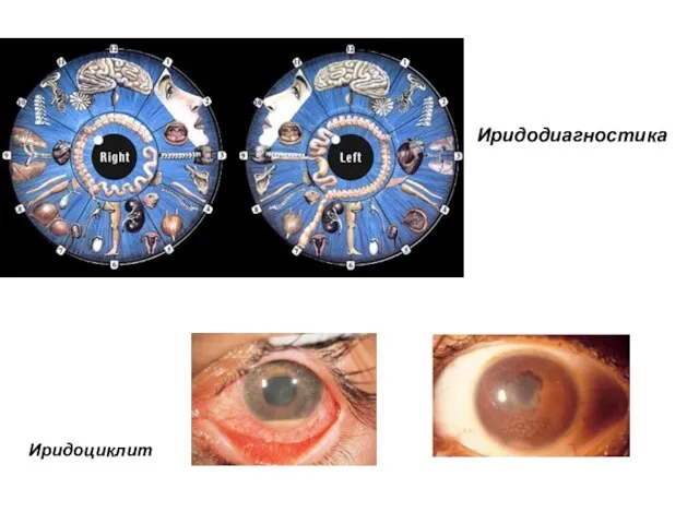 Иридодиагностика Иридоциклит
