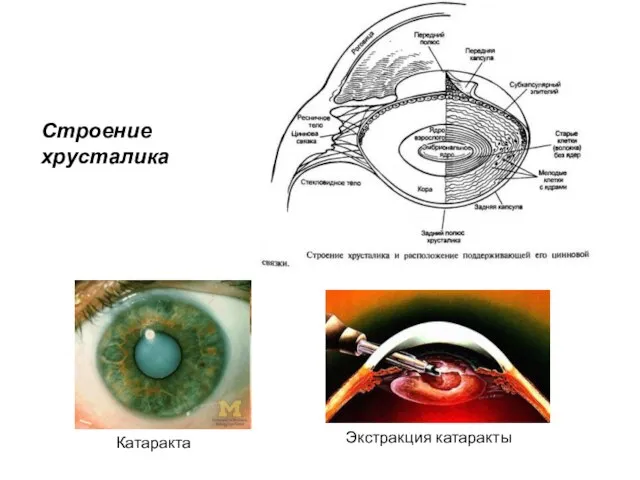 Строение хрусталика Катаракта Экстракция катаракты