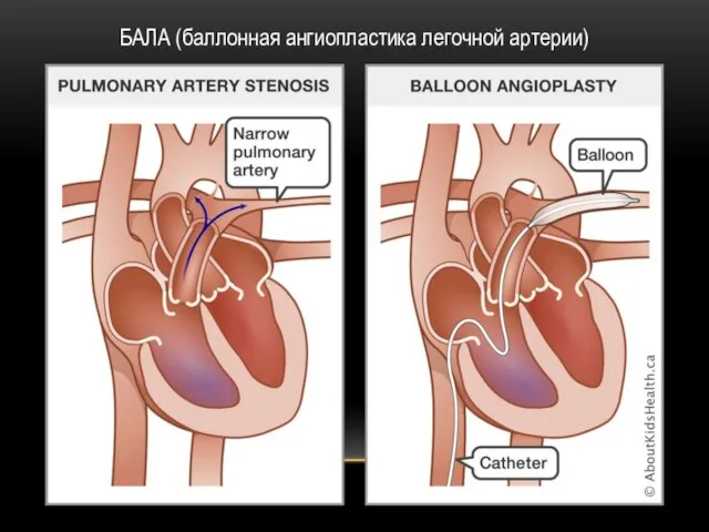БАЛА (баллонная ангиопластика легочной артерии)