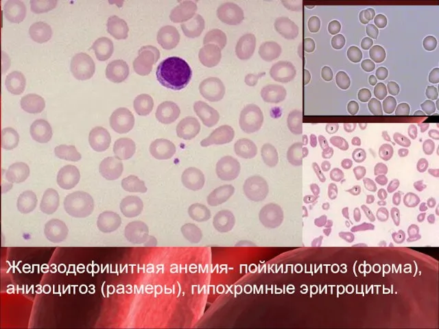 Железодефицитная анемия- пойкилоцитоз (форма), анизоцитоз (размеры), гипохромные эритроциты.