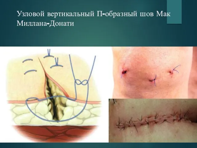 Узловой вертикальный П-образный шов Мак Миллана-Донати