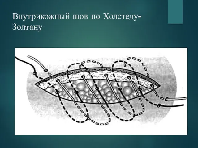 Внутрикожный шов по Холстеду-Золтану