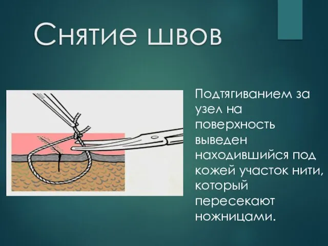 Снятие швов Подтягиванием за узел на поверхность выведен находившийся под кожей участок нити, который пересекают ножницами.