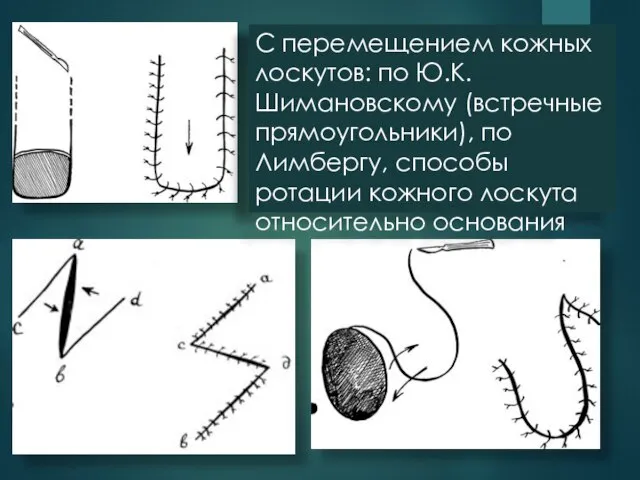 С перемещением кожных лоскутов: по Ю.К. Шимановскому (встречные прямоугольники), по Лимбергу,