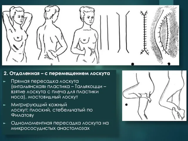 2. Отдаленная – с перемещением лоскута Прямая пересадка лоскута («итальянская» пластика