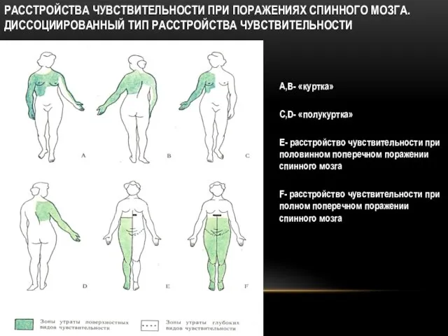 РАССТРОЙСТВА ЧУВСТВИТЕЛЬНОСТИ ПРИ ПОРАЖЕНИЯХ СПИННОГО МОЗГА. ДИССОЦИИРОВАННЫЙ ТИП РАССТРОЙСТВА ЧУВСТВИТЕЛЬНОСТИ А,В-