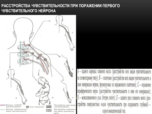 РАССТРОЙСТВА ЧУВСТВИТЕЛЬНОСТИ ПРИ ПОРАЖЕНИИ ПЕРВОГО ЧУВСТВИТЕЛЬНОГО НЕЙРОНА