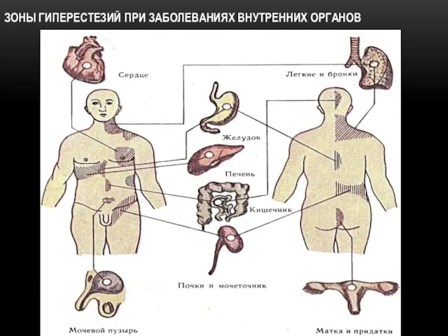 ЗОНЫ ГИПЕРЕСТЕЗИЙ ПРИ ЗАБОЛЕВАНИЯХ ВНУТРЕННИХ ОРГАНОВ