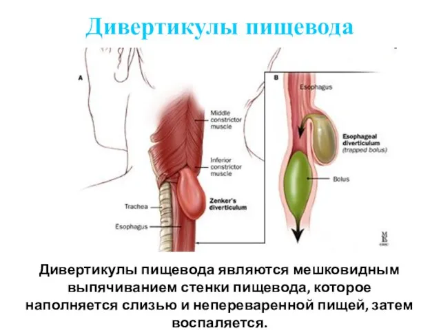 Дивертикулы пищевода Дивертикулы пищевода являются мешковидным выпячиванием стенки пищевода, которое наполняется