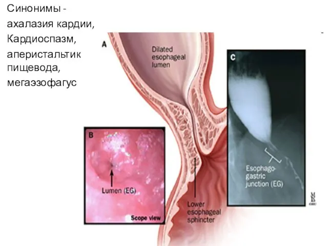 Синонимы - ахалазия кардии, Кардиоспазм, аперистальтика пищевода, мегаэзофагус