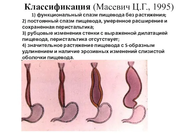 Классификация (Масевич Ц.Г., 1995) 1) функциональный спазм пищевода без растяжения; 2)