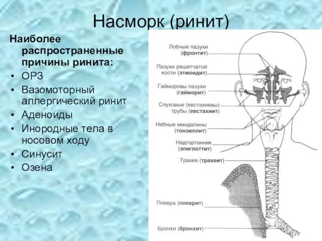 Насморк (ринит) Наиболее распространенные причины ринита: ОРЗ Вазомоторный аллергический ринит Аденоиды