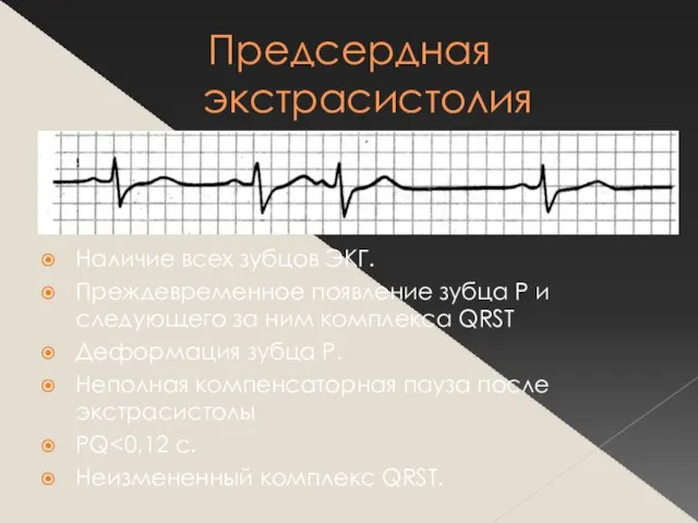 Предсердная экстрасистолия Наличие всех зубцов ЭКГ. Преждевременное появление зубца Р и