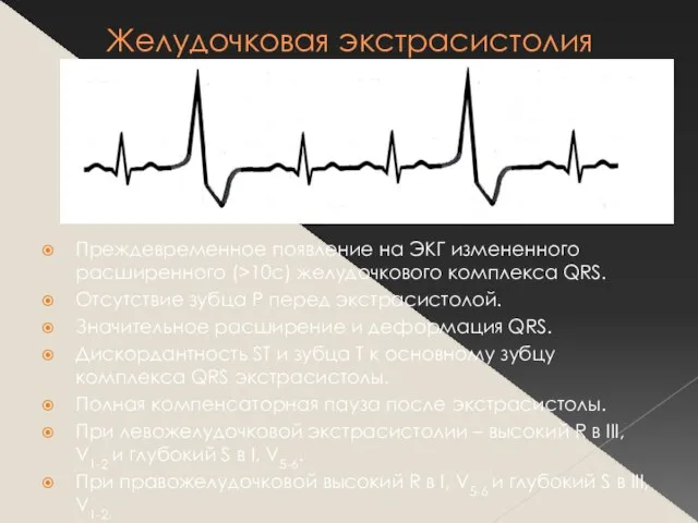 Желудочковая экстрасистолия Преждевременное появление на ЭКГ измененного расширенного (>10с) желудочкового комплекса