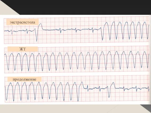 продолжение ЖТ экстрасистола