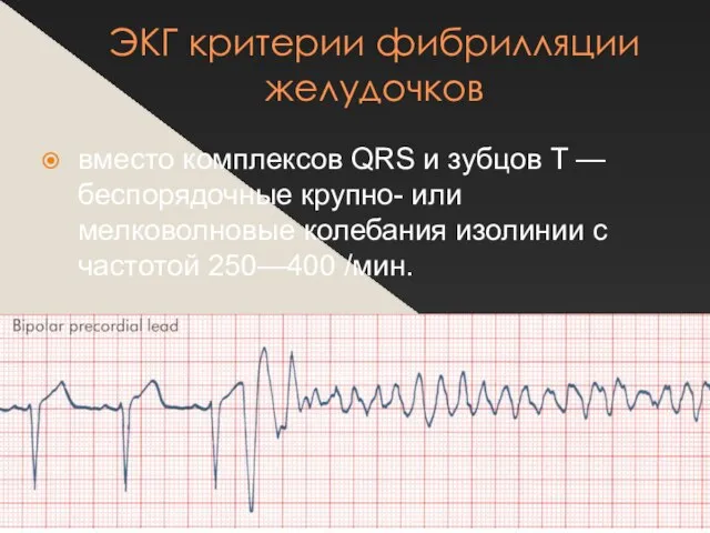 ЭКГ критерии фибрилляции желудочков вместо комплексов QRS и зубцов T —