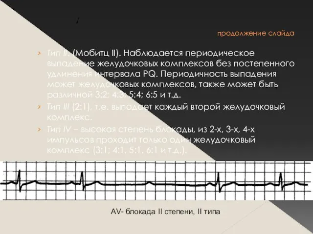 продолжение слайда Тип II. (Мобитц II). Наблюдается периодическое выпадение желудочковых комплексов