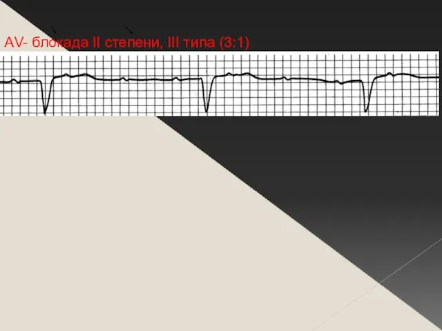 АV- блокада II степени, III типа (3:1)