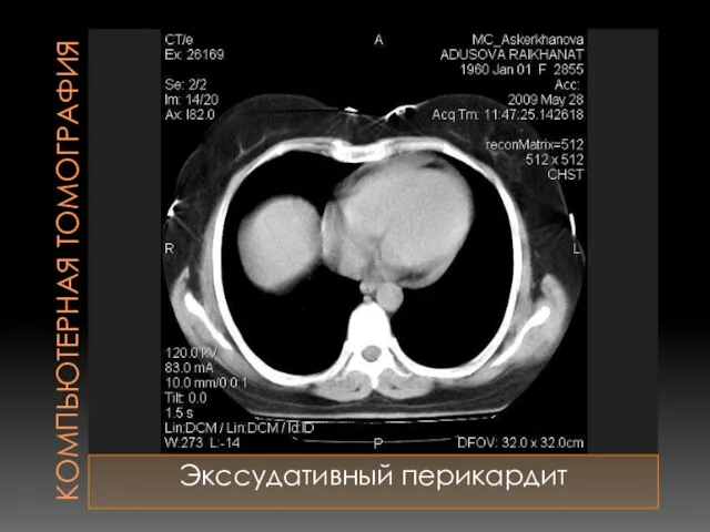 КОМПЬЮТЕРНАЯ ТОМОГРАФИЯ Экссудативный перикардит