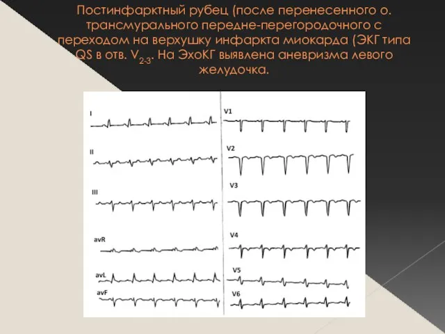 Постинфарктный рубец (после перенесенного о.трансмурального передне-перегородочного с переходом на верхушку инфаркта