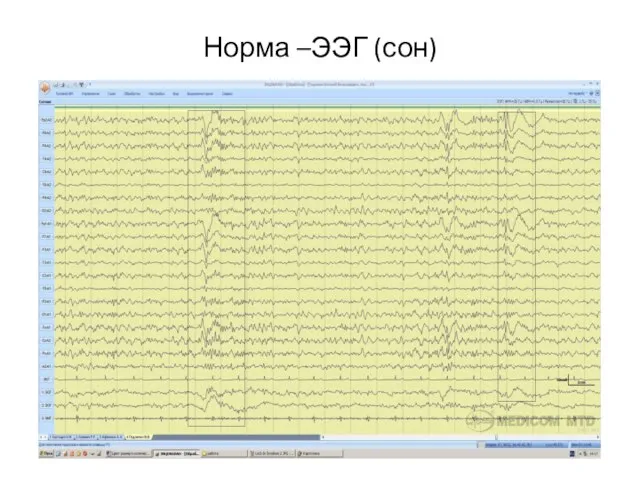 Норма –ЭЭГ (сон)