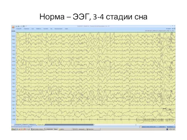 Норма – ЭЭГ, 3-4 стадии сна