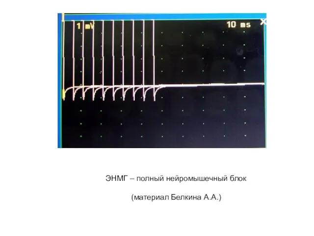 ЭНМГ – полный нейромышечный блок (материал Белкина А.А.) После