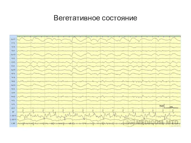 Вегетативное состояние