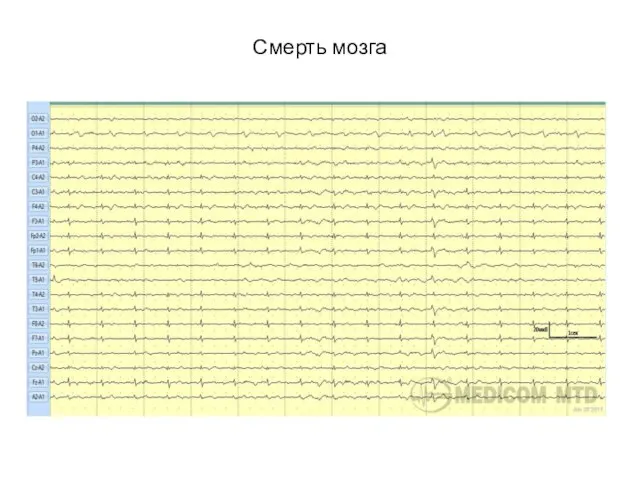 Смерть мозга