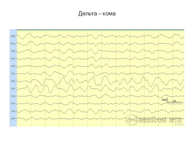 Дельта – кома