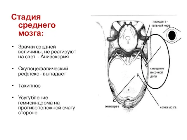 Стадия среднего мозга: Зрачки средней величины, не реагируют на свет -