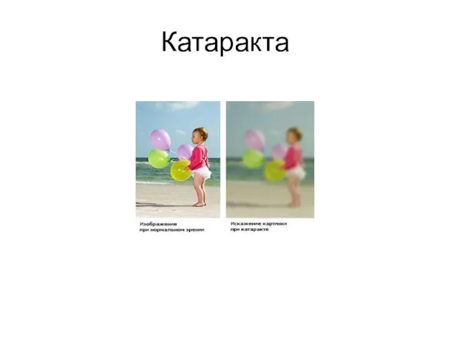 Катаракта