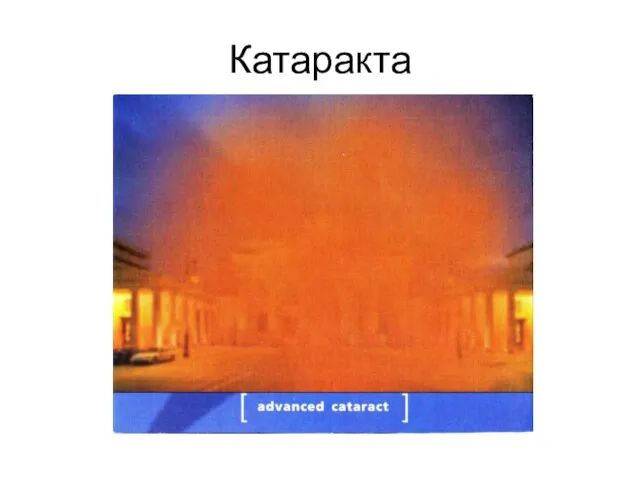 Катаракта