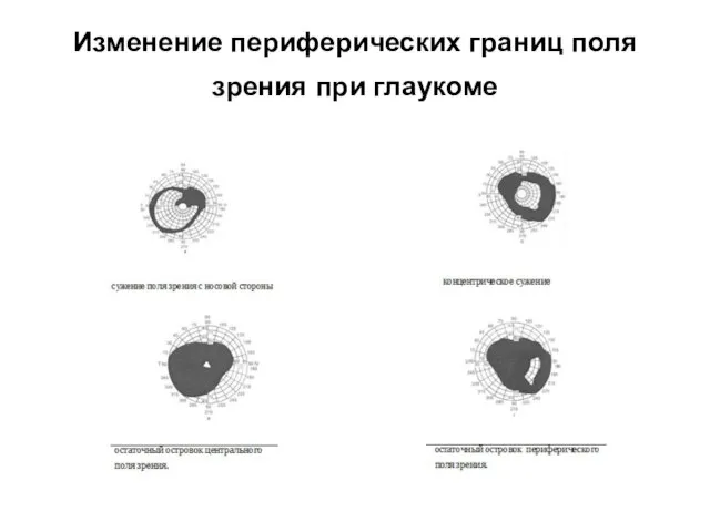 Изменение периферических границ поля зрения при глаукоме