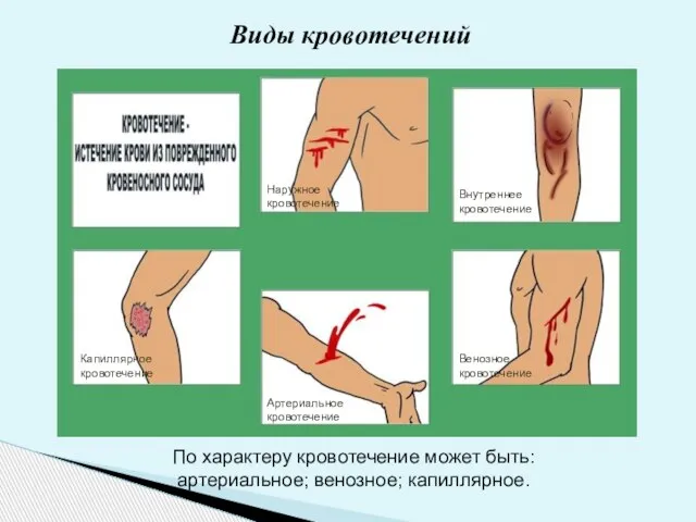 Виды кровотечений Артериальное кровотечение Венозное кровотечение Внутреннее кровотечение Капиллярное кровотечение Наружное