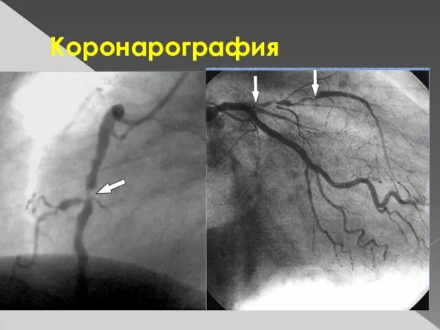 Коронарография
