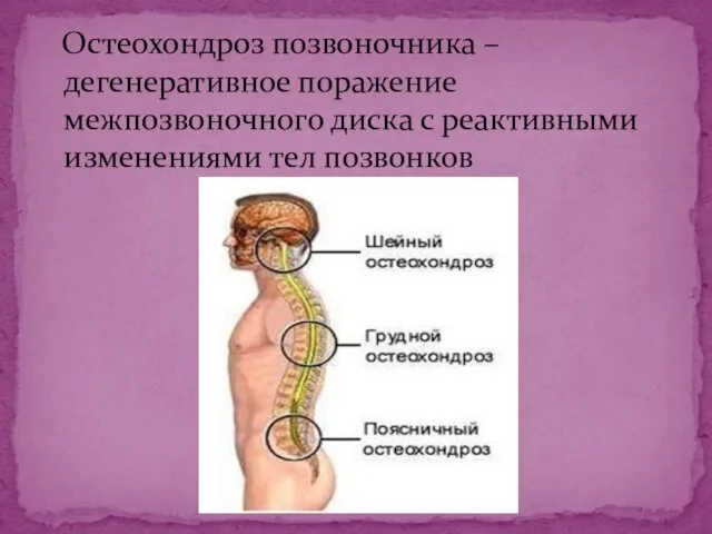 Остеохондроз позвоночника –дегенеративное поражение межпозвоночного диска с реактивными изменениями тел позвонков