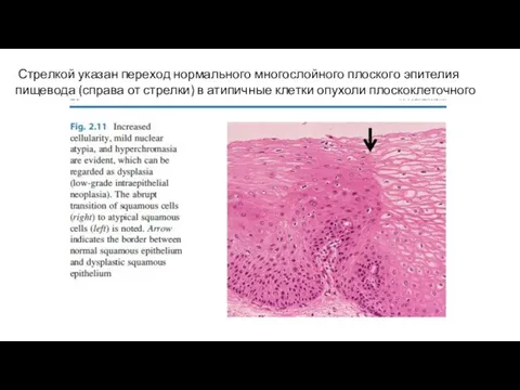 Стрелкой указан переход нормального многослойного плоского эпителия пищевода (справа от стрелки)