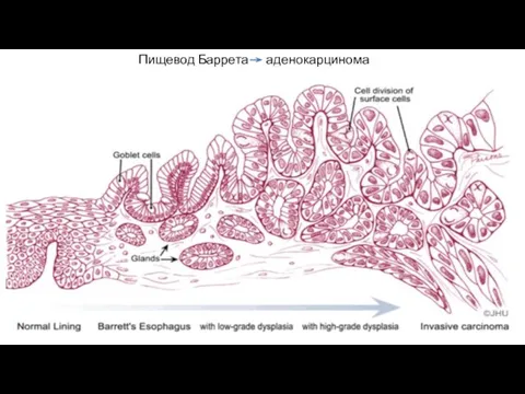 Пищевод Баррета аденокарцинома