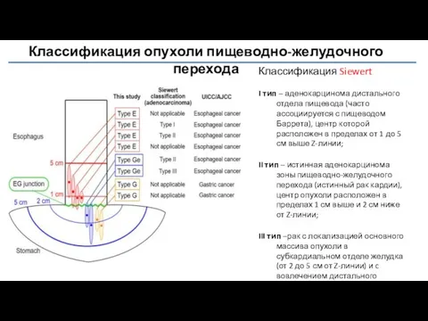 Классификация опухоли пищеводно-желудочного перехода Классификация Siewert I тип – аденокарцинома дистального