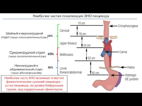 Наиболее частая локализация ЗНО пищевода Шейный и верхнегрудной отдел (чаще плоскоклеточный