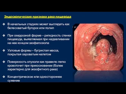 Эндоскопические признаки рака пищевода В начальных стадиях может выглядеть как белесоватый