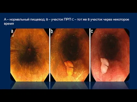 А – нормальный пищевод; B – участок ПРП C – тот