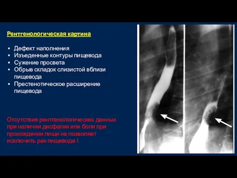 Рентгенологическая картина Дефект наполнения Изъеденные контуры пищевода Сужение просвета Обрыв складок