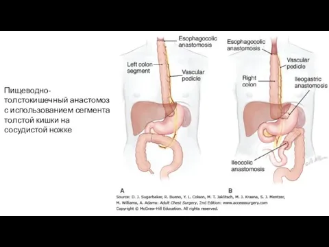 Пищеводно-толстокишечный анастомоз с использованием сегмента толстой кишки на сосудистой ножке