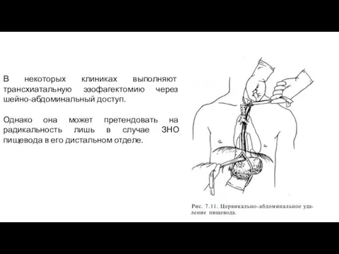 В некоторых клиниках выполняют трансхиатальную эзофагектомию через шейно-абдоминальный доступ. Однако она